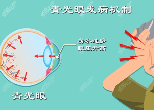青光眼发病机制