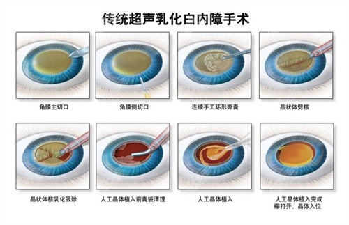 超声乳化白内障手术