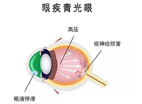 青光眼开角型和闭角型