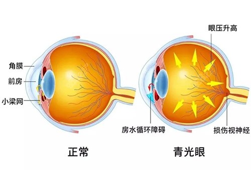 青光眼症状