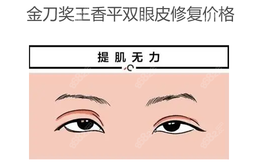 金刀奖王香平双眼皮修复价格2万元起,比刘志刚眼修复价格低