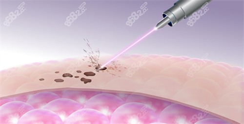 激光改善皮肤斑点