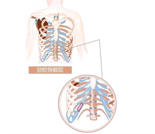 武汉付毅医生肋软骨隆鼻价格