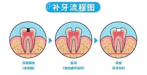 补牙流程图