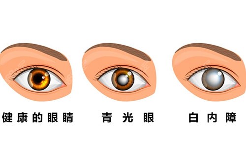 青光眼开角型和闭角型区别