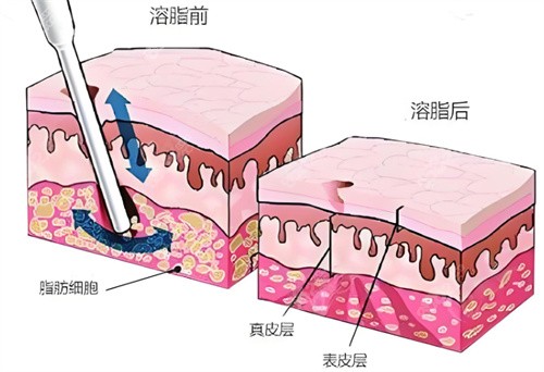 射频溶脂术皮肤层.jpg