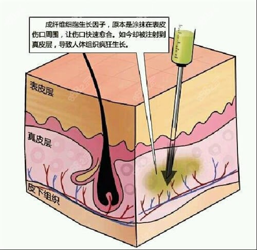 生长因子皮肤层次示意图