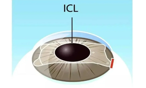 人工晶体近视眼手术有危害吗？近视眼手术优缺点都有哪些?