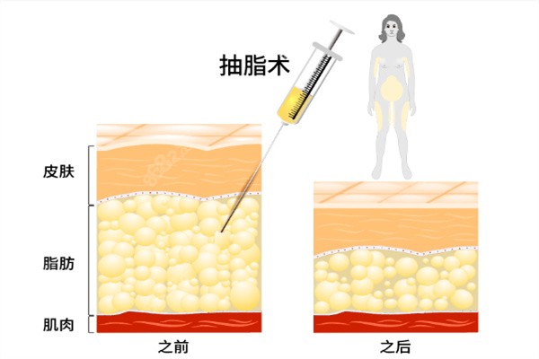 殷初阳医生吸脂价格多少