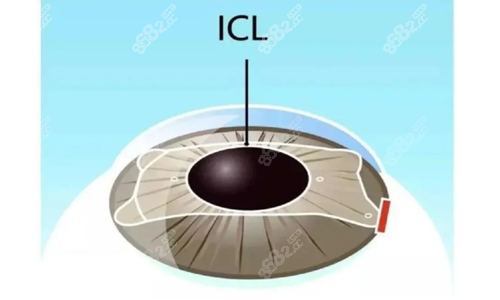 IcL植入示意图