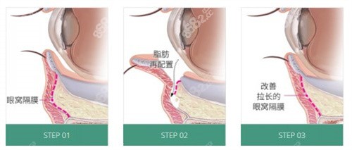眼底脂肪重排术.jpg