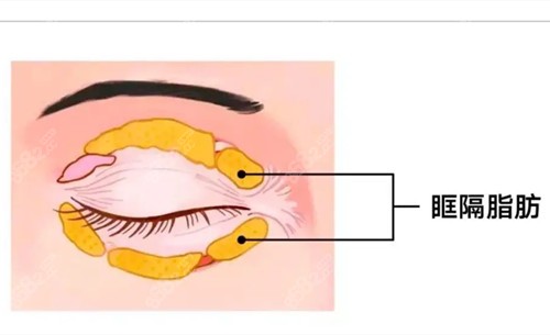 眼周眶隔脂肪卡通示意图.jpg