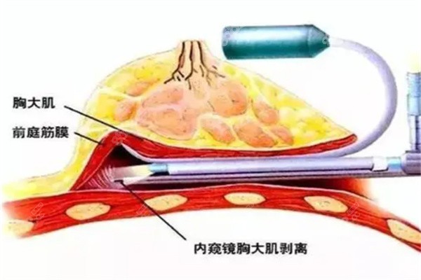 殷初阳医生隆胸怎么样