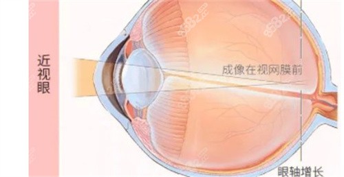 近视眼的成像.jpg