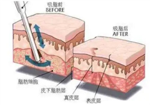 重庆铜雀台吸脂怎么样？