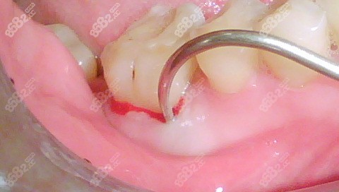 牙龈治疗细节图