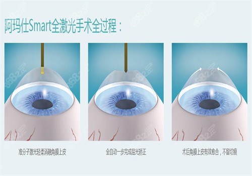 开州爱尔阳光眼科医院可以做近视手术