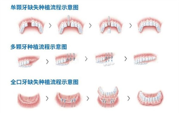 牙齿种植