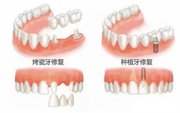 牙齿种植