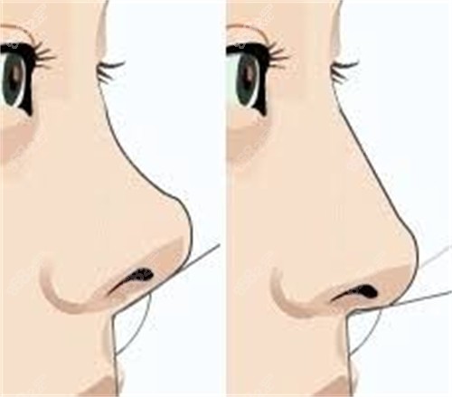 鼻整形前后对比图.jpg
