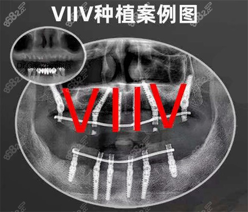 上海鼎植口腔可以做VIIV种植牙技术出色