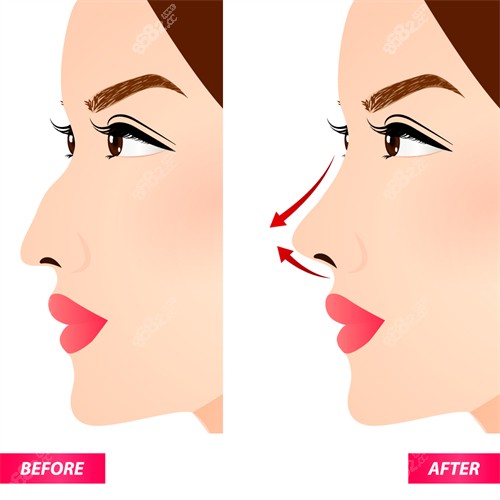 隆鼻手术改善鼻子角度.jpg