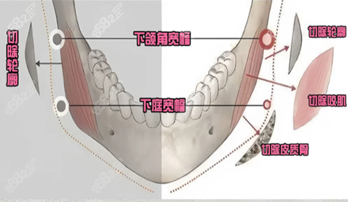 新型V-line和下颌整形手术\区别\优缺点项目指南!