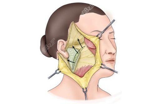 发际耳后切口拉皮手术示意图.jpg