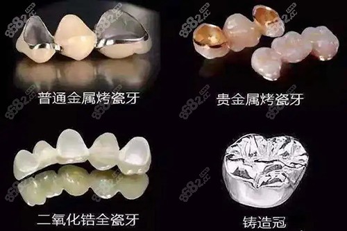 不同材质的牙冠照片