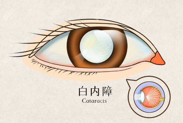 白内障手术