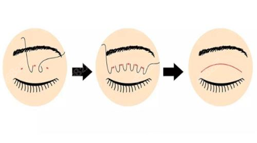 埋线双眼皮示意图