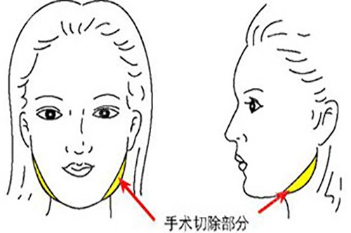 下颌宽大削骨示意图1.jpg