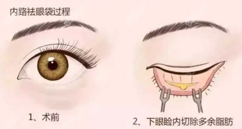 北京八大处祛眼袋3.5K起！王太玲/李海东医生的技术非常可靠