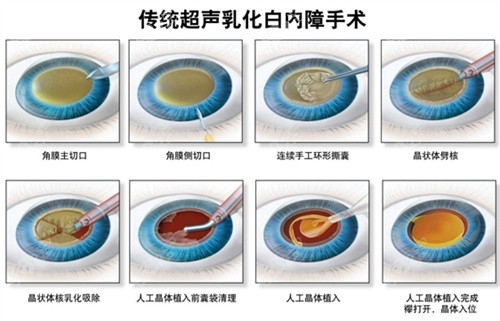 白内障手术方式