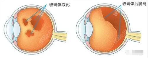 玻璃体问题图片