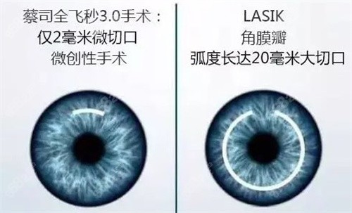 蔡司全飞秒3.0手术和LASIK对比