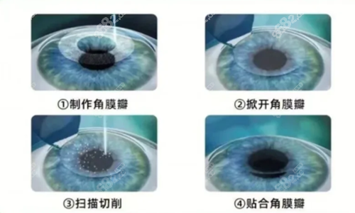 半飞秒手术示意图.png