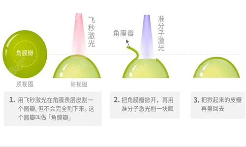 半飞秒手术过程示意图.png