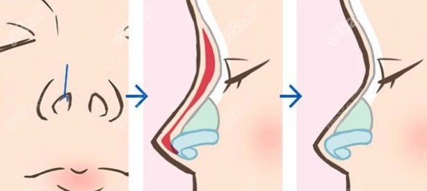 上海韩嘉毅做鼻风格解析