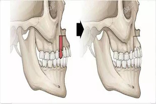 重庆能做正颌手术医院是哪家?松山整形正颌手术正规靠谱
