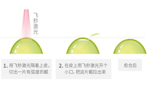 全飞秒手术过程示意图.png