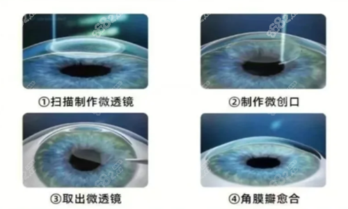 全飞秒手术示意图.png