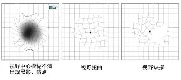 视物扭曲
