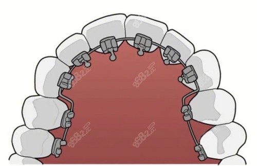 广州柏德口腔舌侧隐形矫正技术娴熟