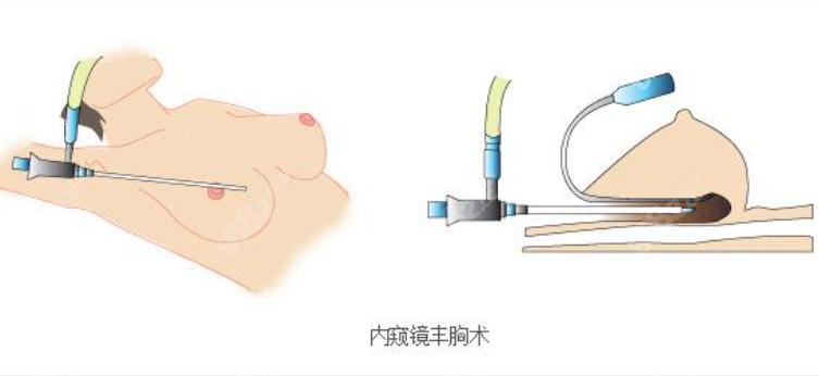 沸腾丰胸术价格表