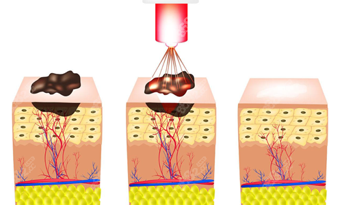 激光去胎记过程示意图