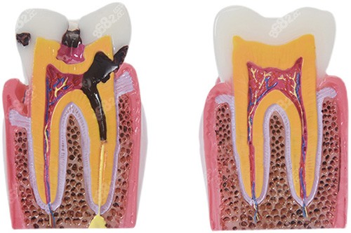 牙根龋坏模型图片.jpg