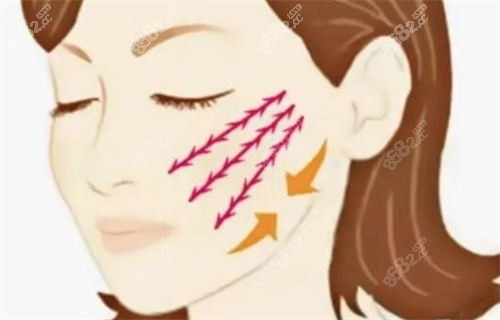 面部拉皮动画展示图