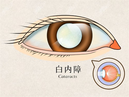 白内障动画照片