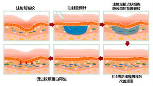 注射童颜针后皮肤变化